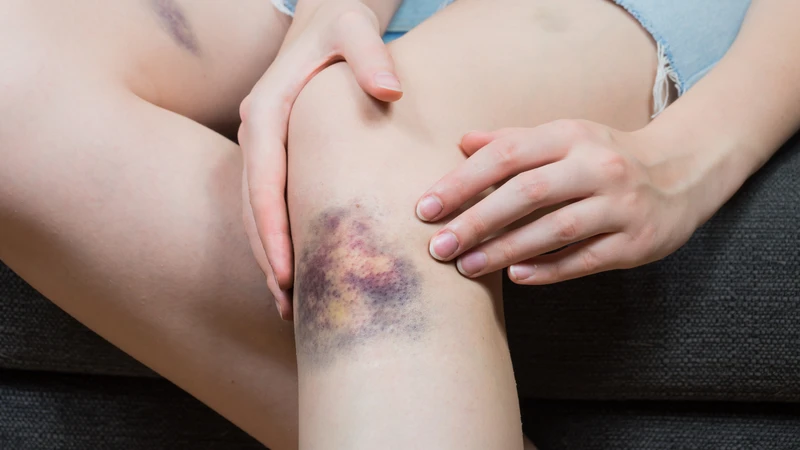 Không nên chủ quan nếu vết bầm xuất hiện kèm một vài dấu hiệu