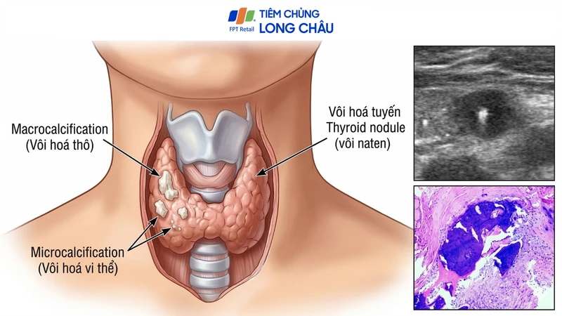 Vị trí vôi hoá tuyến giáp trong cấu trúc tuyến giáp