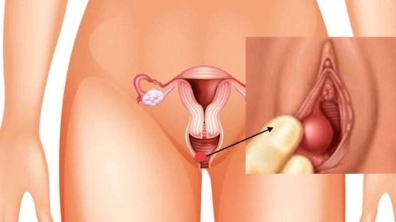 Vùng kín nổi cục cứng đau là dấu hiệu của bệnh gì?  3