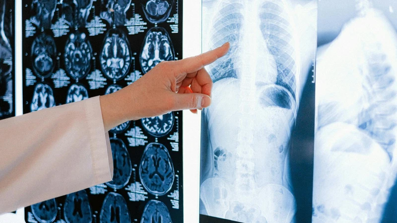 X-quang giãn phế quản: Nhận biết hình ảnh và vai trò trong chẩn đoán 3
