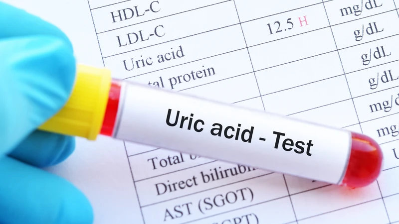 Xét nghiệm acid uric là phương pháp đo nồng độ acid uric trong máu hoặc nước tiểu