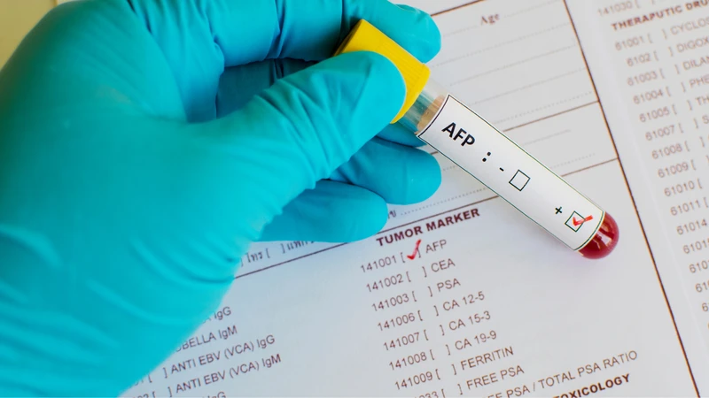 Xét nghiệm AFP là gì? Ý nghĩa của chỉ số xét nghiệm này 1