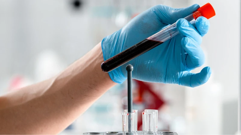 Xét nghiệm CRP thường được chỉ định nhằm theo dõi hiệu quả điều trị ung thư