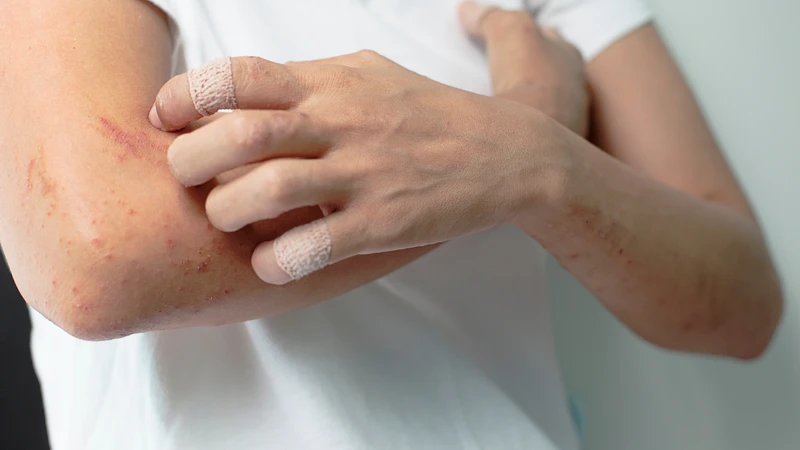 Ngứa da kéo dài có thể là một trong những dấu hiệu cảnh báo đang bị nhiễm ký sinh trùng
