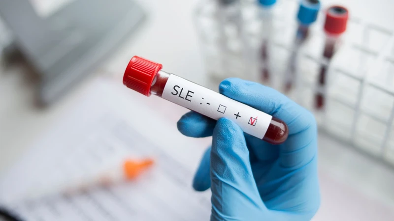 Thực hiện xét nghiệm SLE hỗ trợ bác sĩ phát hiện sớm bệnh Lupus ban đỏ