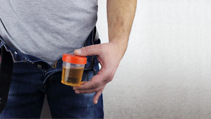 Mẫu nước tiểu cần được lấy và bảo quản đúng hướng dẫn