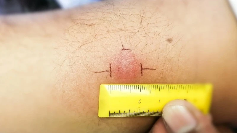 Xét nghiệm Mantoux là gì? Những ai nên thực hiện xét nghiệm này? 2