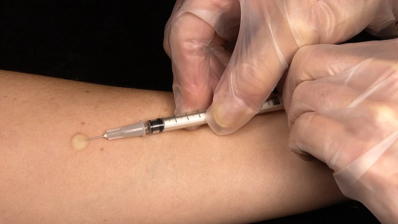 Xét nghiệm Mantoux là gì? Những ai nên thực hiện xét nghiệm này? 3