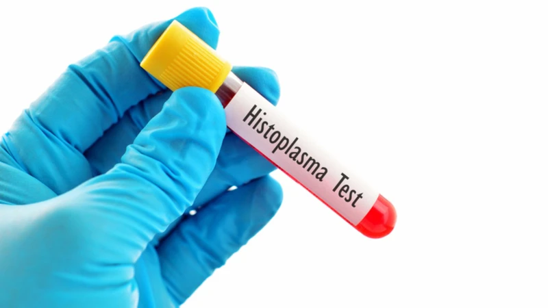 Xét nghiệm máu là một trong các phương pháp hỗ trợ chẩn đoán nhiễm nấm Histoplasma