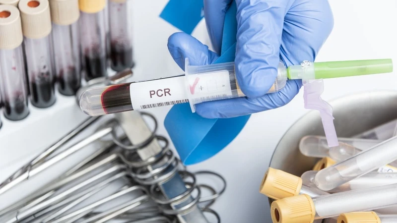 Xét nghiệm PCR lao: Phương pháp chẩn đoán chính xác và nhanh chóng bệnh lao 2