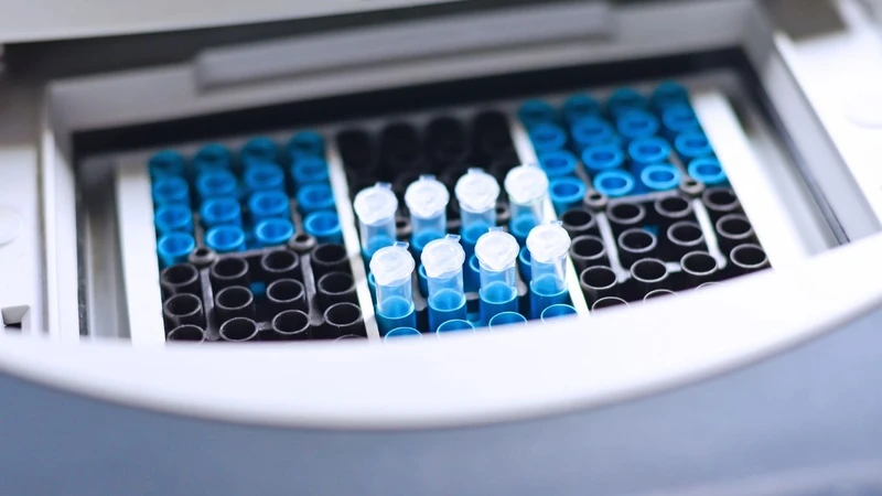 Xét nghiệm PCR lao: Phương pháp chẩn đoán chính xác và nhanh chóng bệnh lao 5