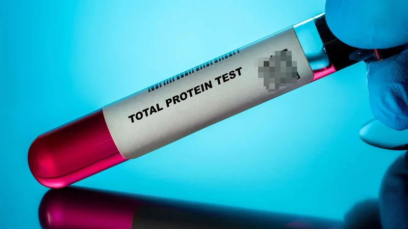 Xét nghiệm protein toàn phần giúp đánh giá albumin và globulin, hỗ trợ theo dõi hoạt động của nhiều cơ quan