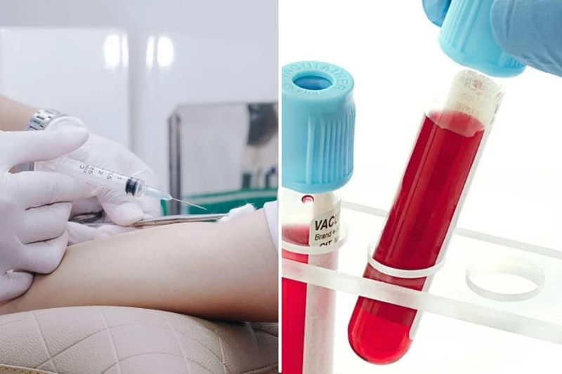 Xét nghiệm viêm gan B bao nhiêu tiền và cần lưu ý gì?2