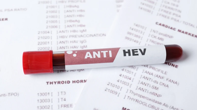 Xét nghiệm viêm gan E: Những điều cần biết trước khi thực hiện 1