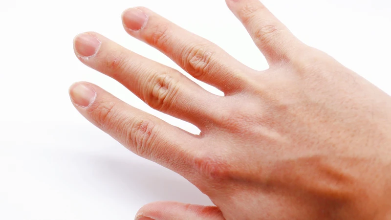 Da dày, cứng và mất đàn hồi là dấu hiệu điển hình của xơ cứng bì khu trú