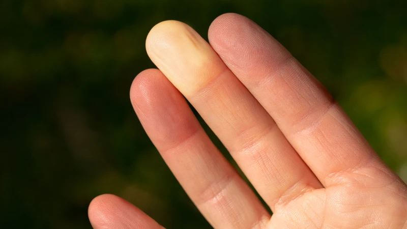 Raynaud là triệu chứng sớm thường gặp của xơ cứng bì toàn thể với biểu hiện tê đau và đổi màu đầu ngón tay