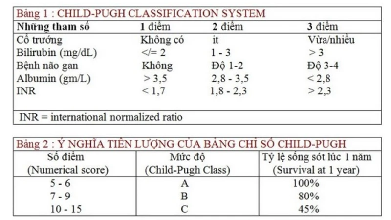 Xơ gan Child Pugh là gì và ý nghĩa như thế nào? 2