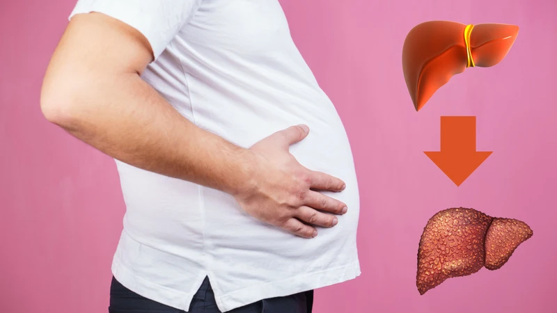 Xơ gan cổ trướng có lây không? Hiểu rõ bệnh để phòng ngừa hiệu quả 3