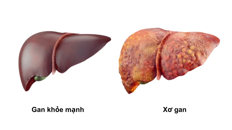 Xơ gan F3 có chữa được không? 1
