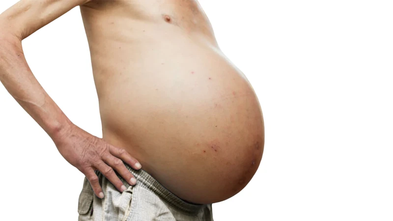 Xơ gan giai đoạn cuối: Triệu chứng, điều trị và vai trò của tiêm phòng vắc xin 3
