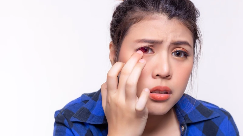 Xuất huyết mắt có nguy hiểm không? Dấu hiệu nhận biết và cách xử lý an toàn 1