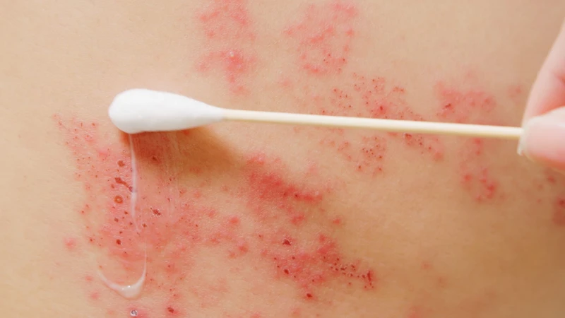 Zona thần kinh ở bụng có đặc điểm gì? Biện pháp để phòng ngừa bệnh 3
