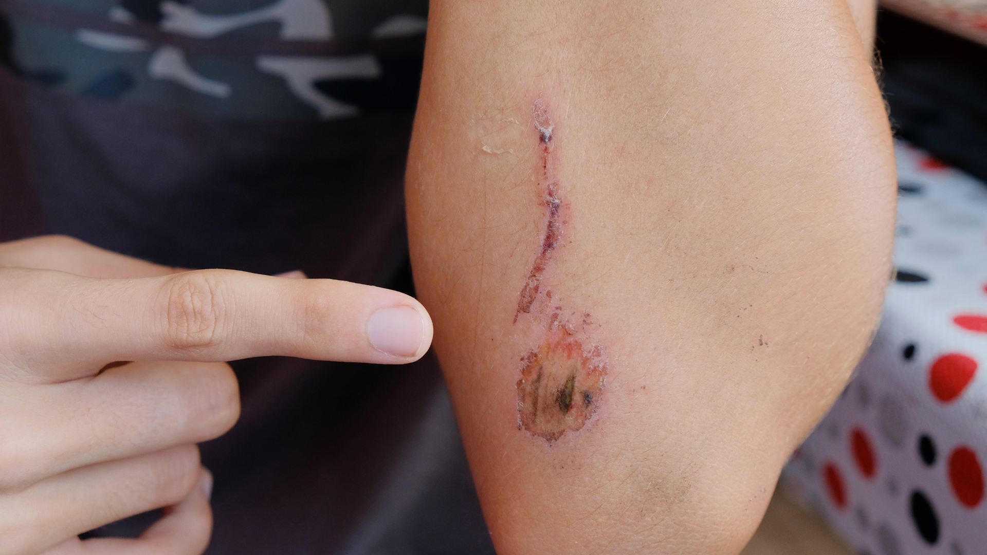 Uốn ván là bệnh nhiễm trùng nguy hiểm từ vết thương hở