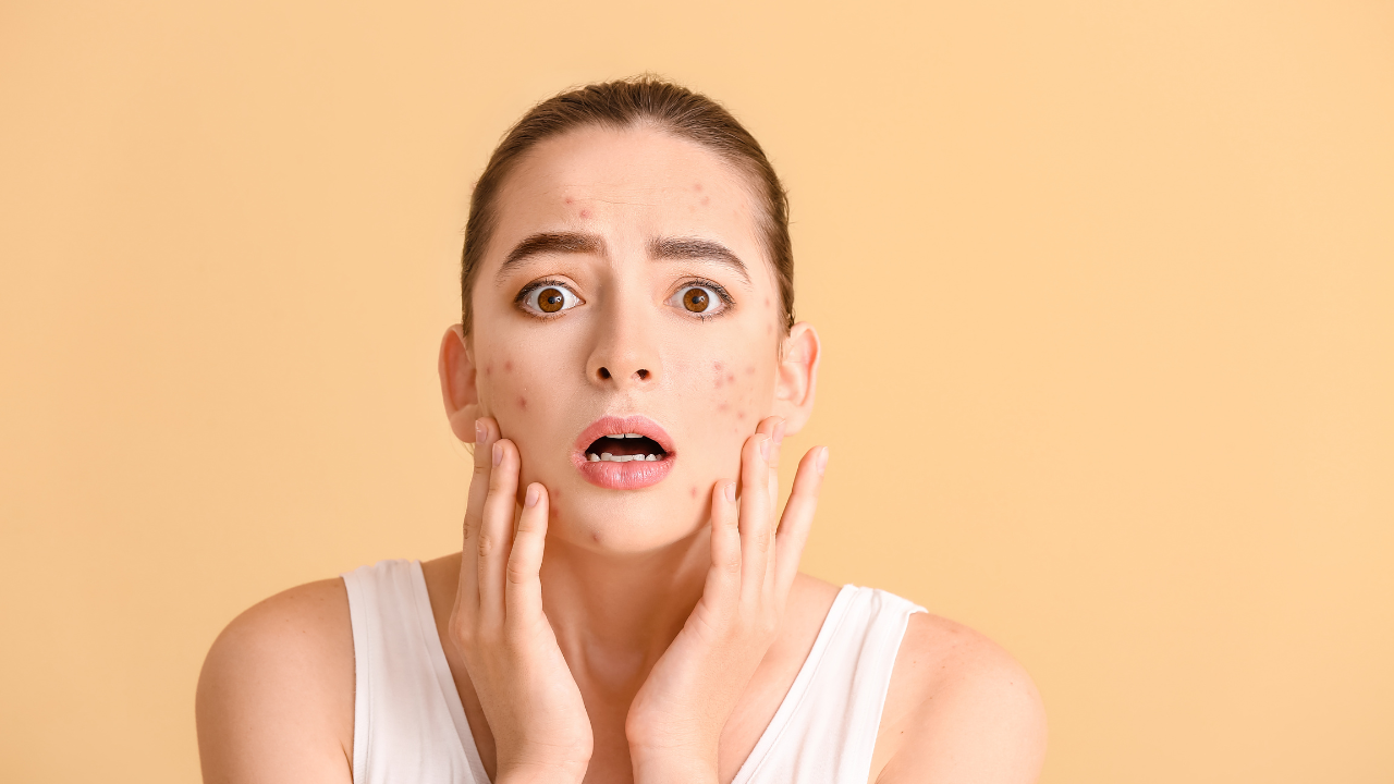 Một số trường hợp uống collagen bị nổi mụn