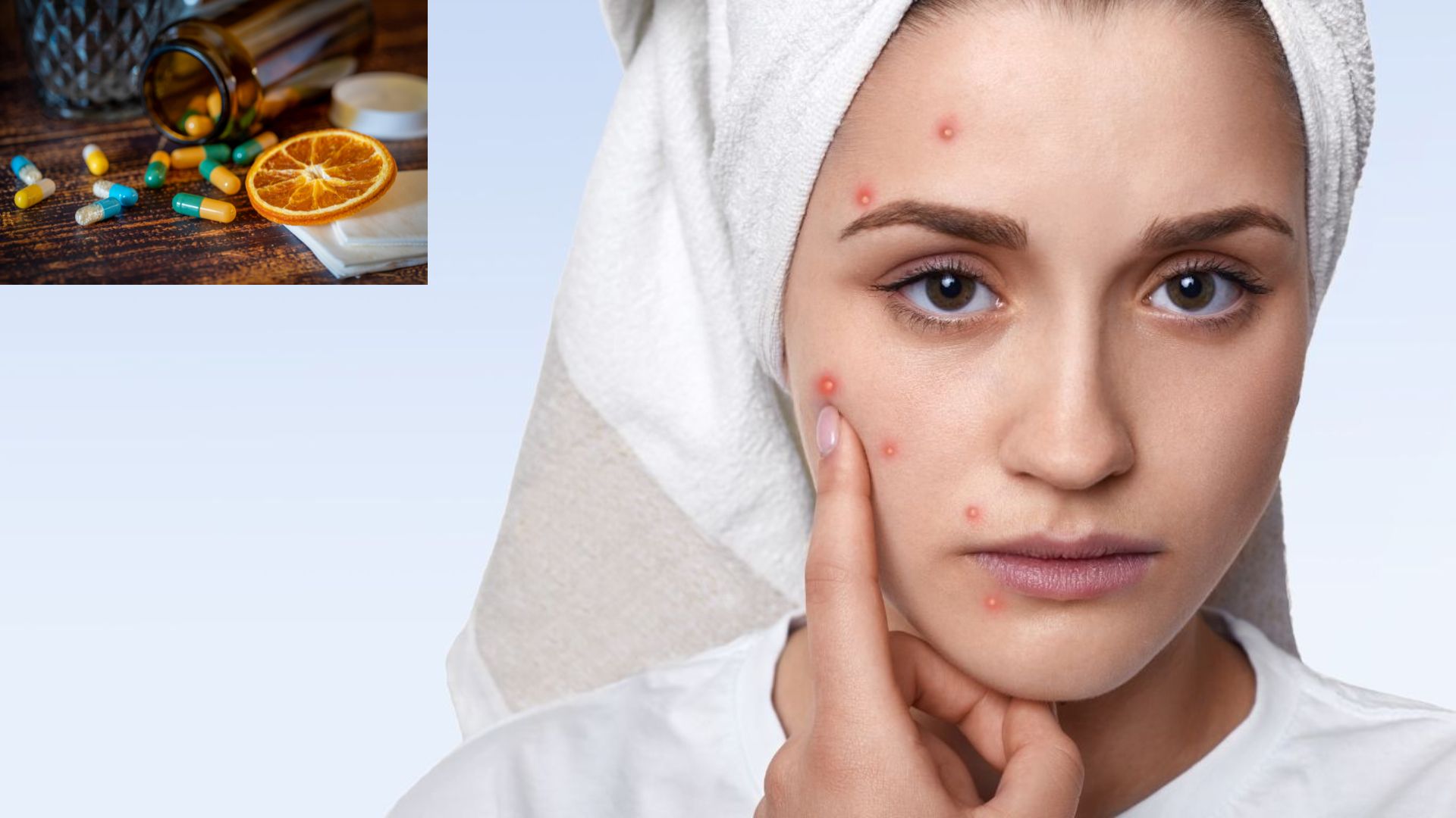 Uống kẽm trị mụn nội tiết liệu có hiệu quả như lời đồn