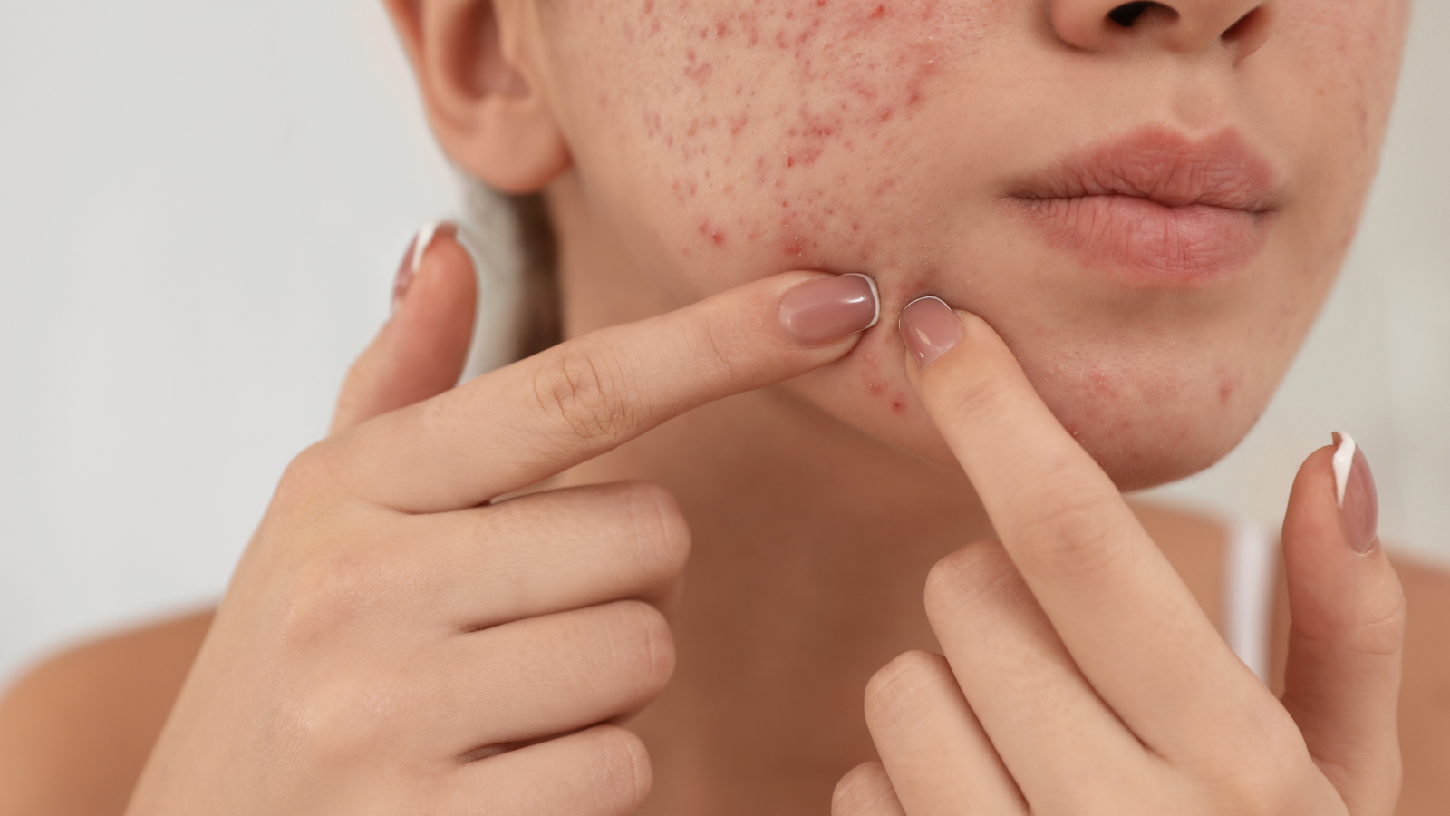 Nước cam không chỉ giúp ngăn ngừa mụn mà còn hỗ trợ giảm viêm