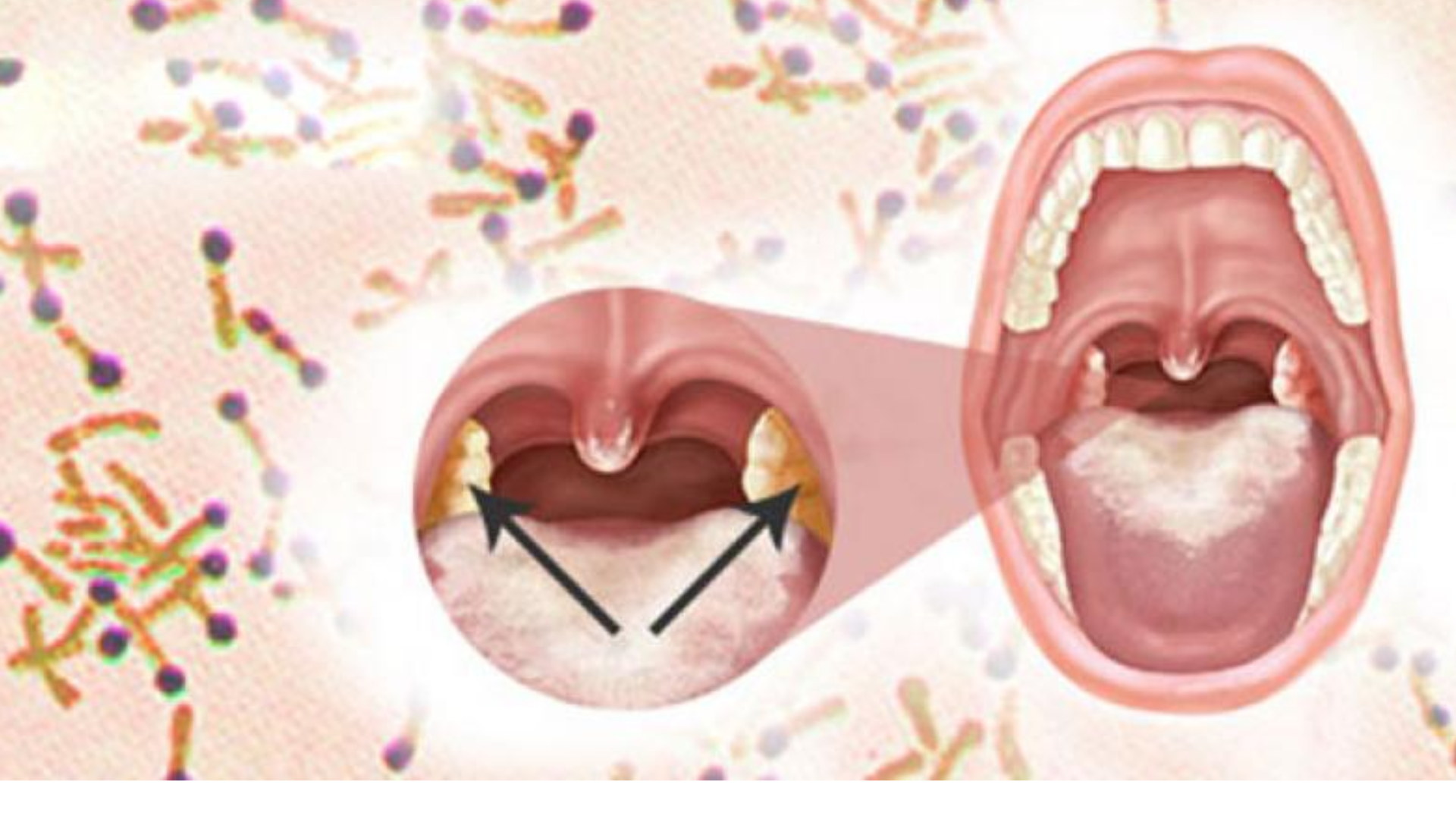 vac-xin-bach-hau-co-hieu-qua-trong-bao-lau (1).png