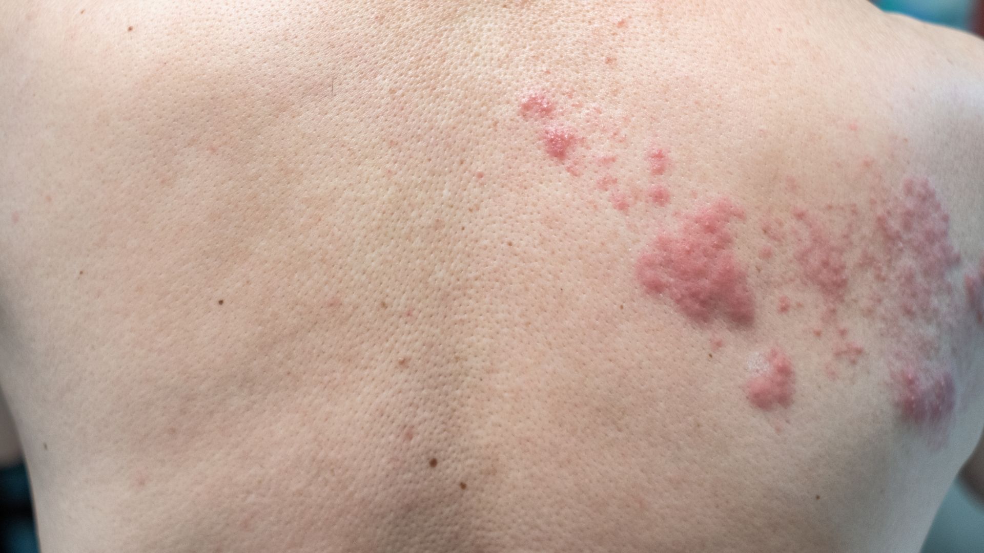 Các nhà nghiên cứu cho rằng vắc xin ảnh hưởng đến phản ứng viêm của cơ thể