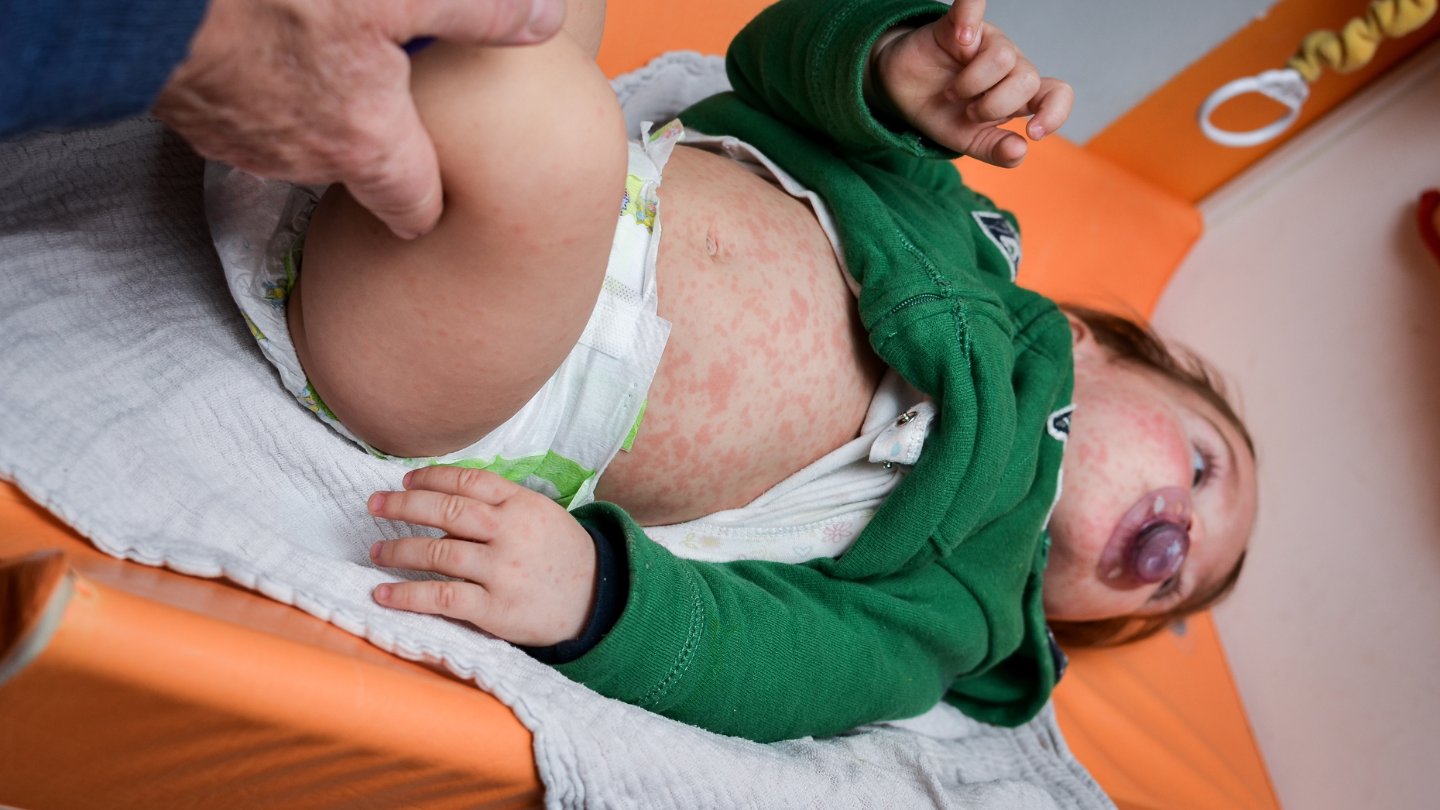 vai-tro-xet-nghiem-khang-the-soi-va-tam-quan-trong-trong-phong-ngua-va-kiem-soat-benh-soi 2.png