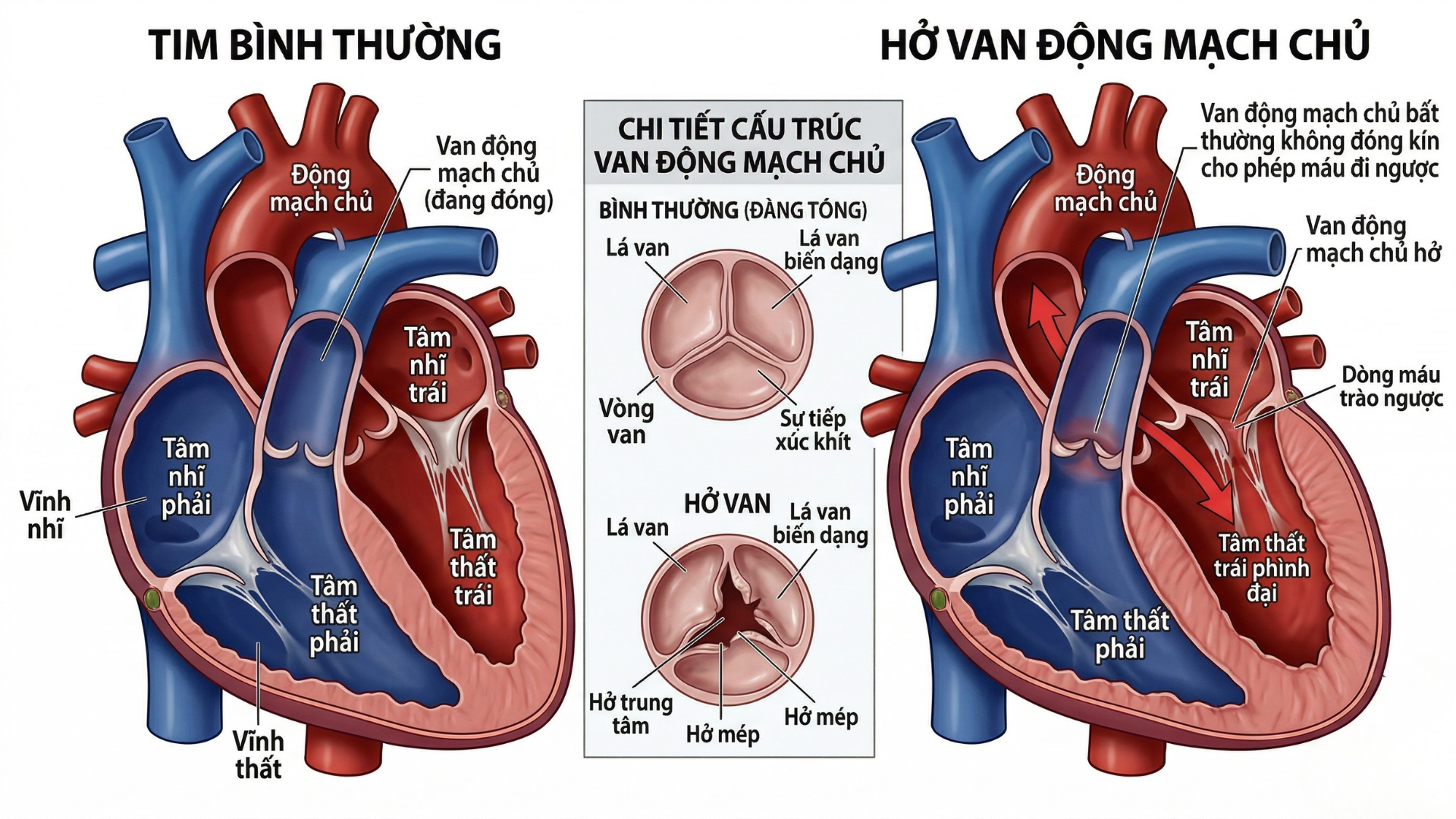 Van động mạch phổi giúp máu lưu thông một chiều từ tim đến phổi