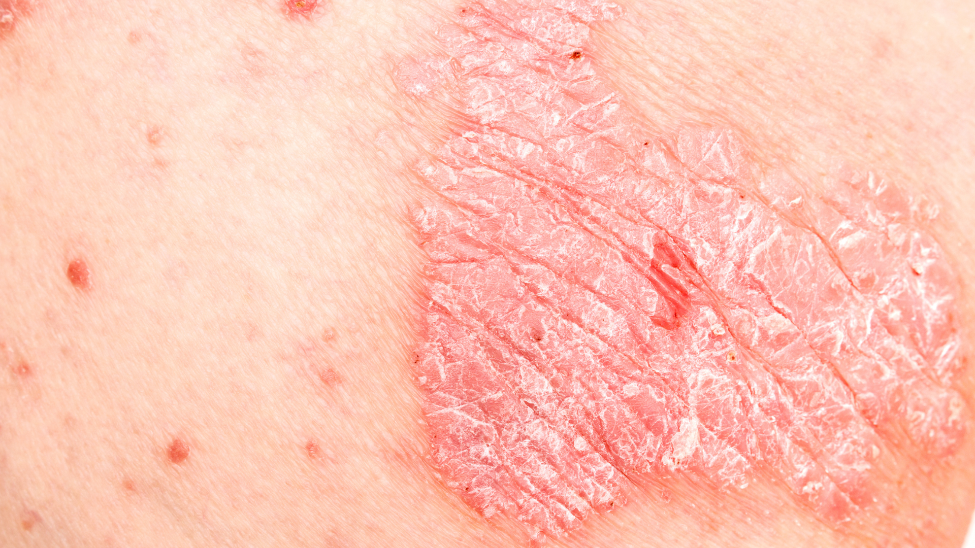 Sự căng thẳng, stress có thể khiến cho vảy nến lan rộng