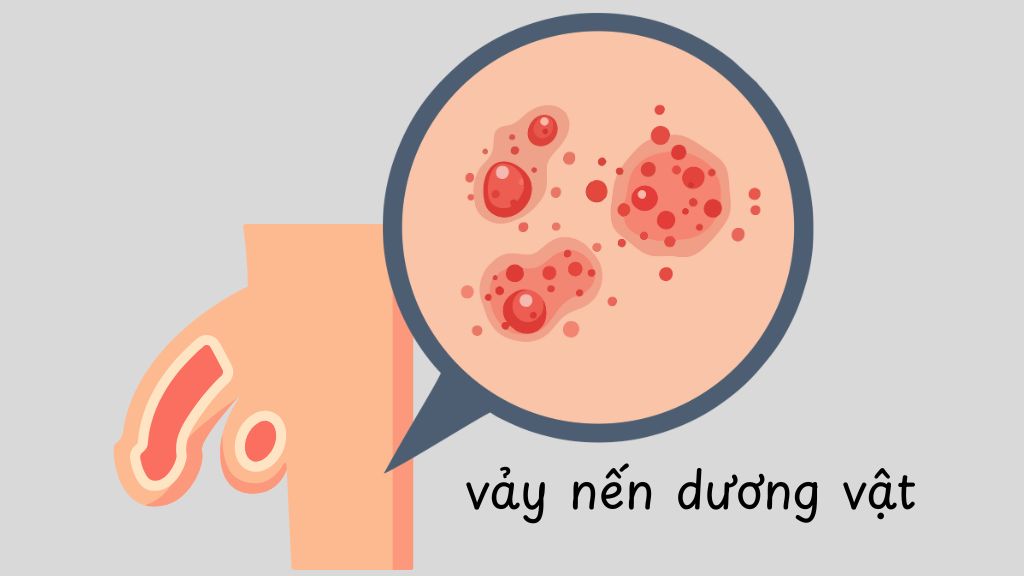Vảy nến là một bệnh lý da liễu mạn tính có cơ chế tự miễn