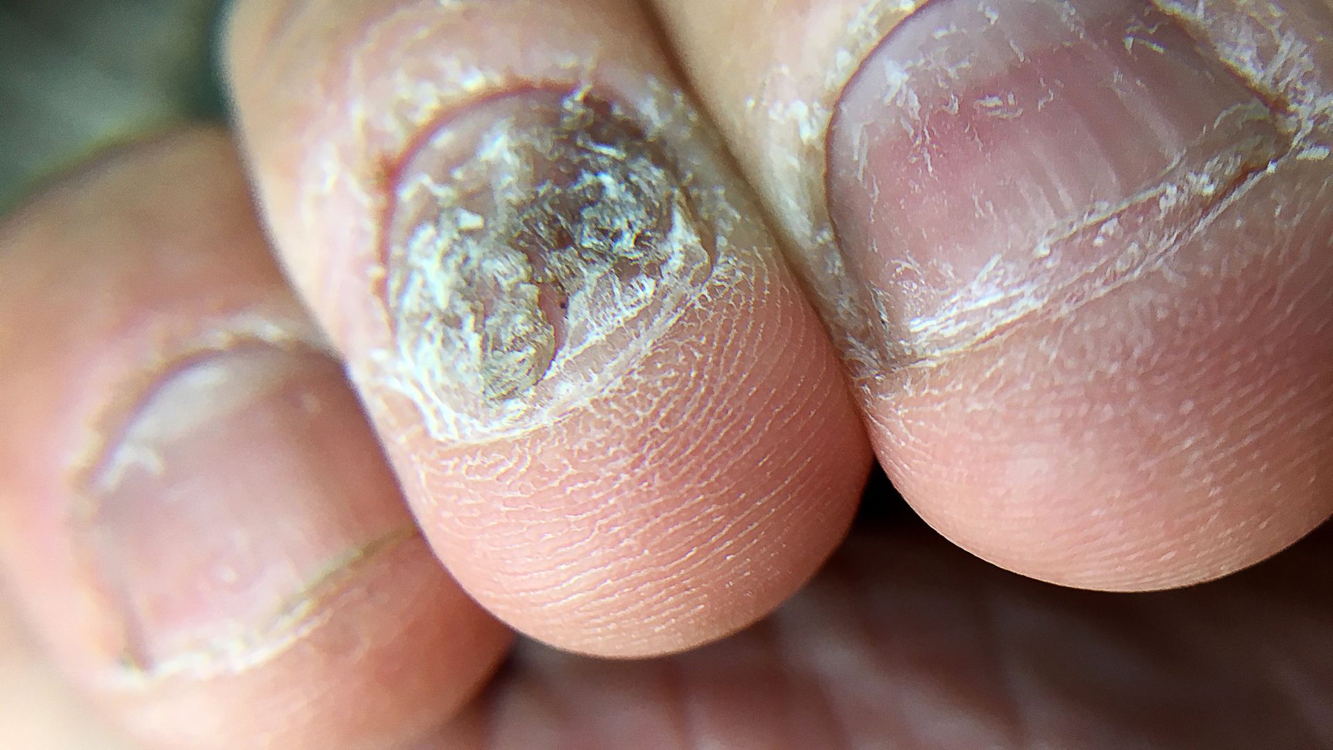 Vảy nến móng tay khiến móng bị dày, đổi màu và sần sùi