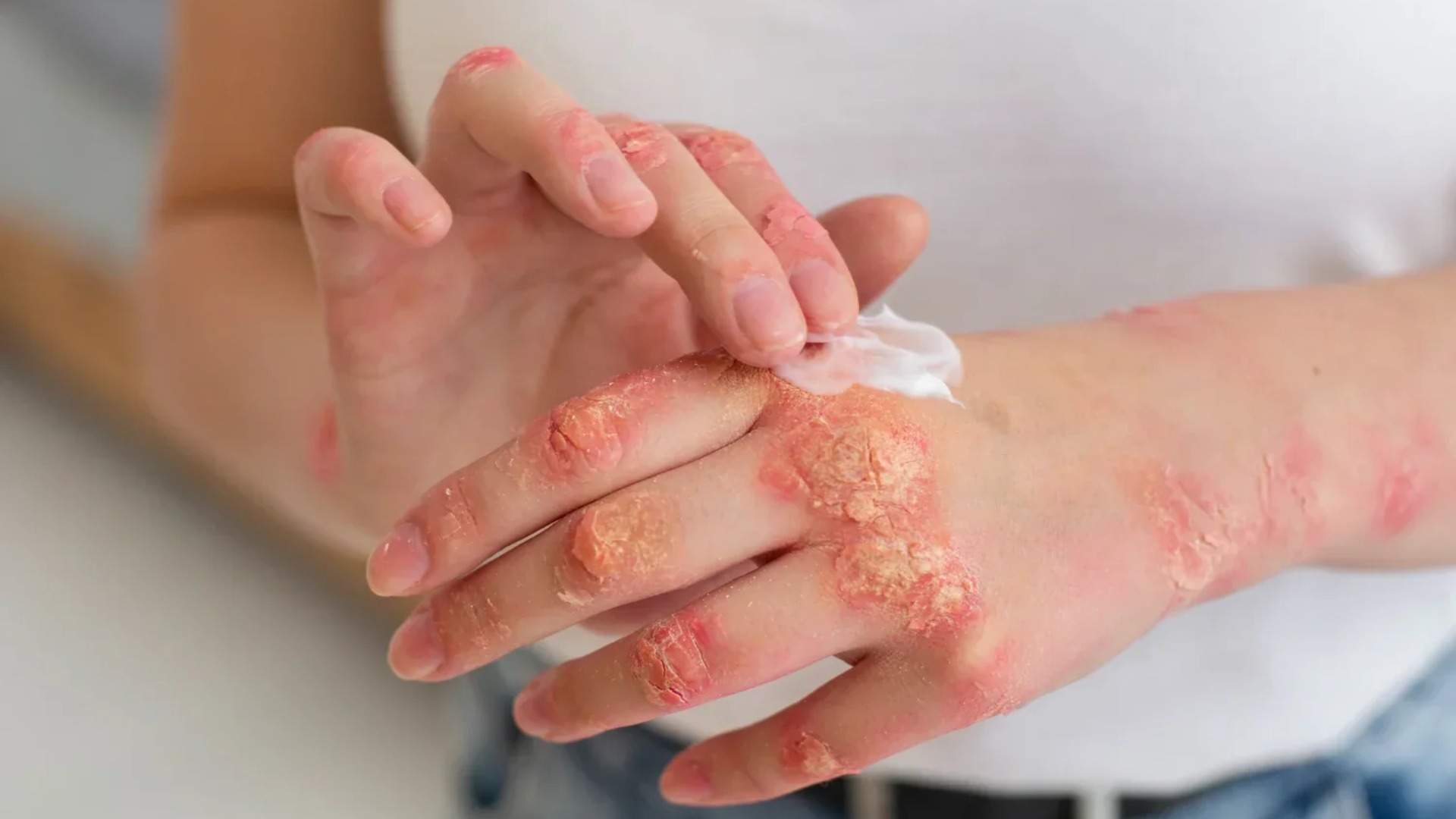 Vảy nến thể mảng là tình trạng viêm da mạn tính, nổi bật với mảng đỏ phủ nhiều lớp vảy trắng bạc dễ bong
