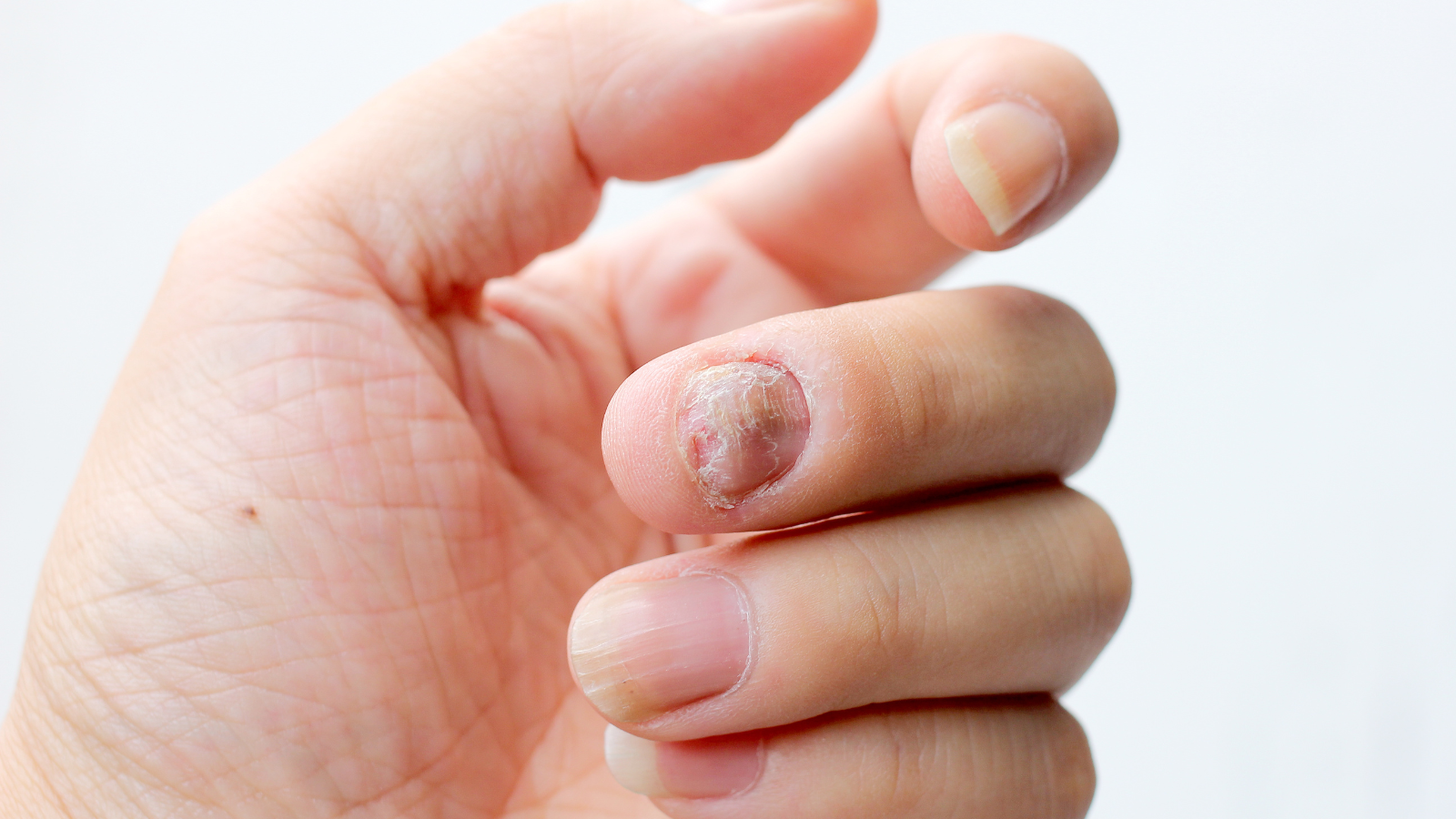Vảy nến thể mủ có thể gây loạn sản móng hoặc mất móng