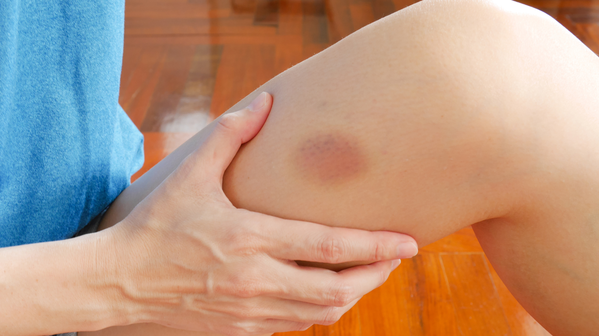 Vết bầm chuyển sang màu vàng có sao không? Cách khắc phục tình trạng này 1