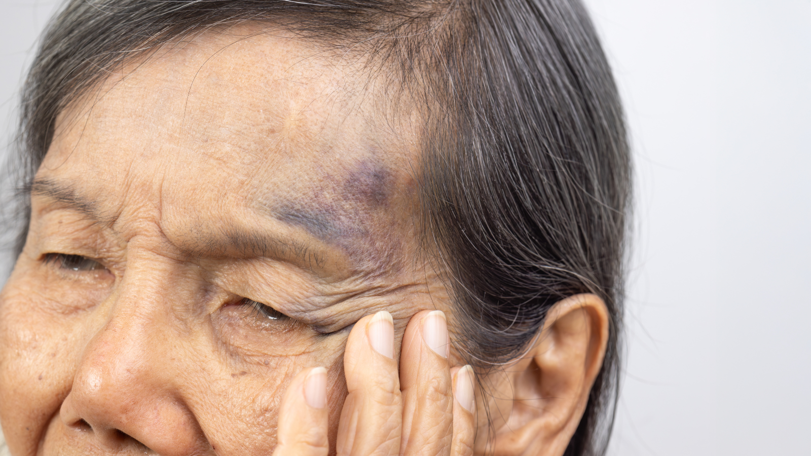 Người lớn tuổi, thiếu vitamin thường bị bầm tím lâu tan hơn