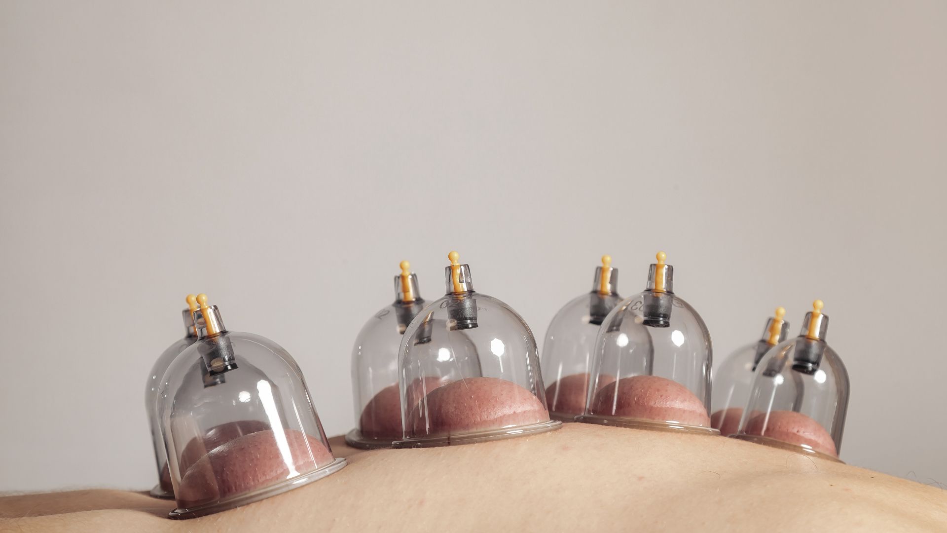 Vết bầm tím khi giác hơi bao lâu thì hết là câu hỏi thắc mắc của nhiều người