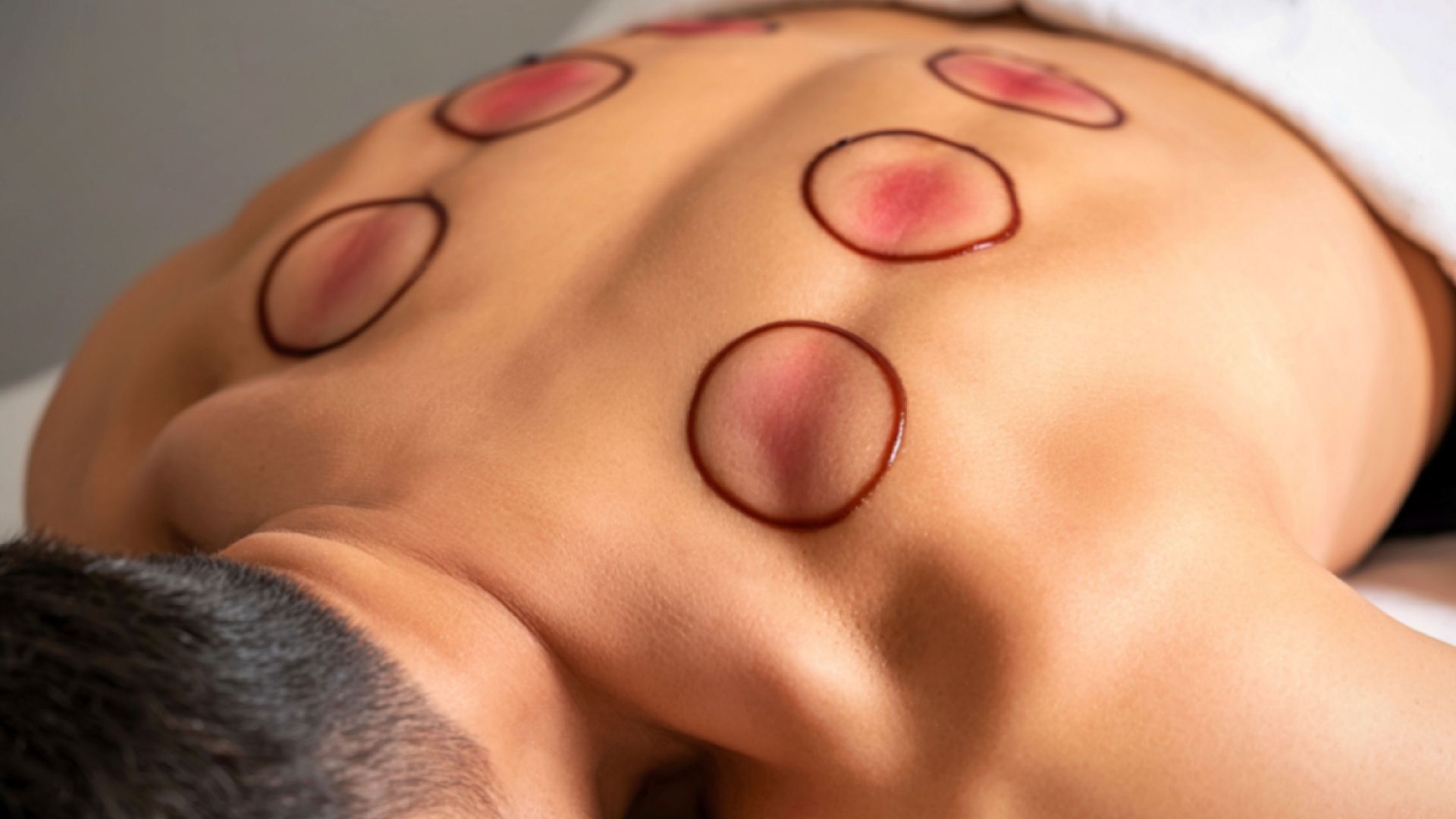 Vết bầm tím khi giác hơi hình thành do áp lực bên trong cốc thay đổi đột ngột, tác động lên mạch máu nhỏ dưới da