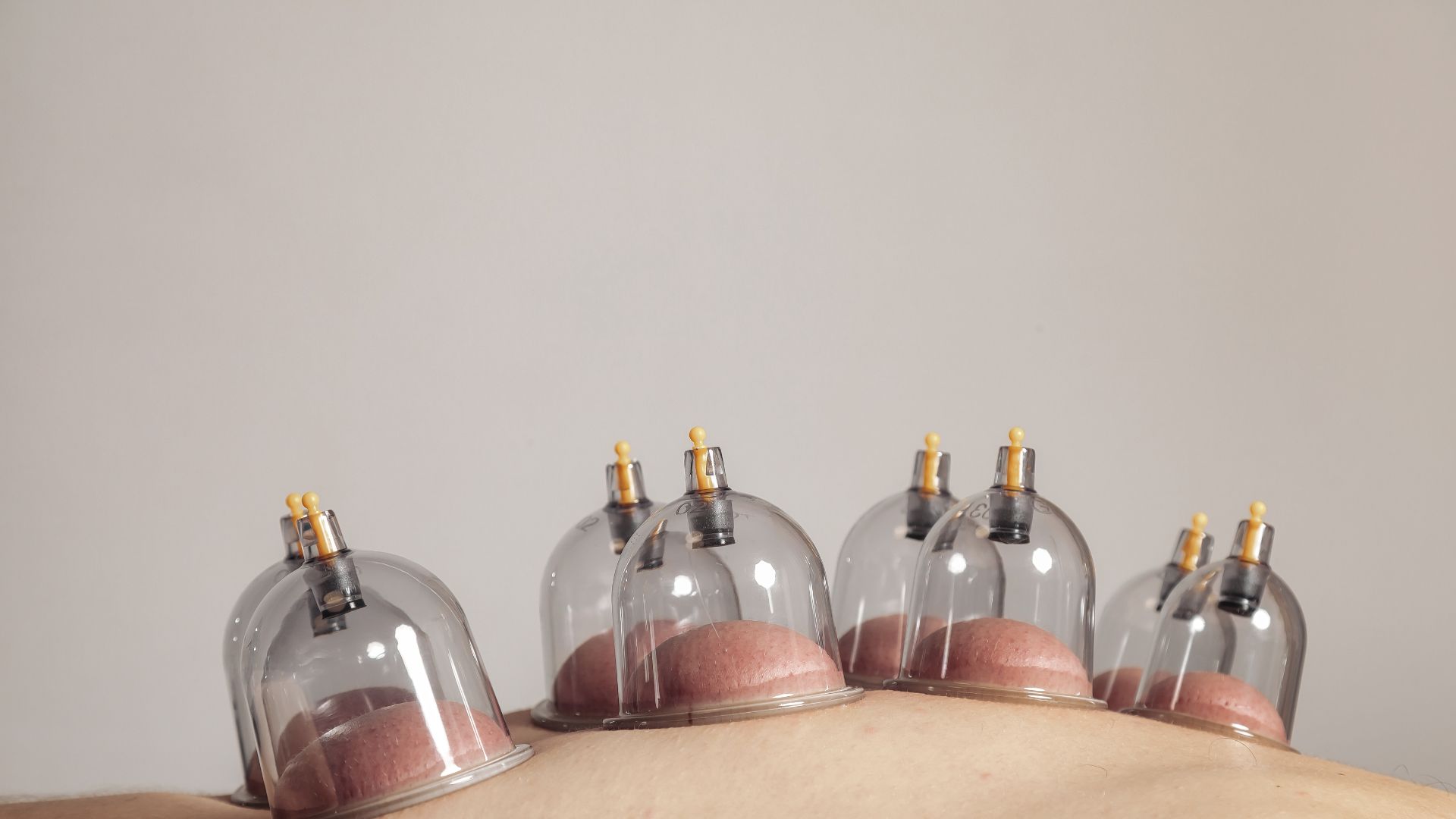 Mức độ vết bầm tím khi giác hơi thay đổi tùy cơ địa, thời gian và lực hút của cốc giác