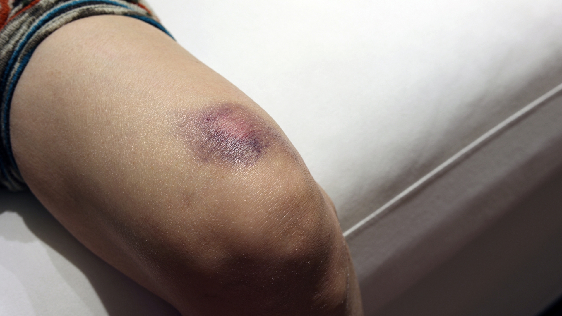 Vết bầm tím trên da có thể là báo hiệu của bất thường về sức khỏe cần chú ý, nhất là những vết bầm xuất hiện không do va đập