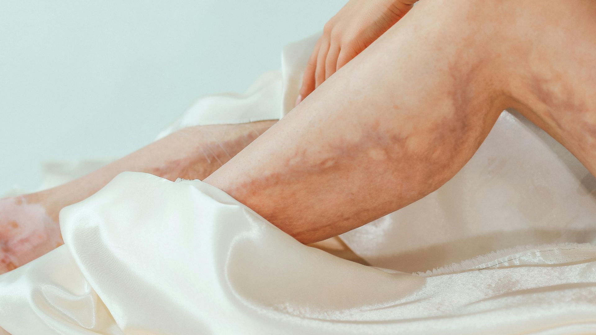 Một số yếu tố như mạch máu yếu có thể khiến da dễ xuất hiện vết bầm hơn bình thường