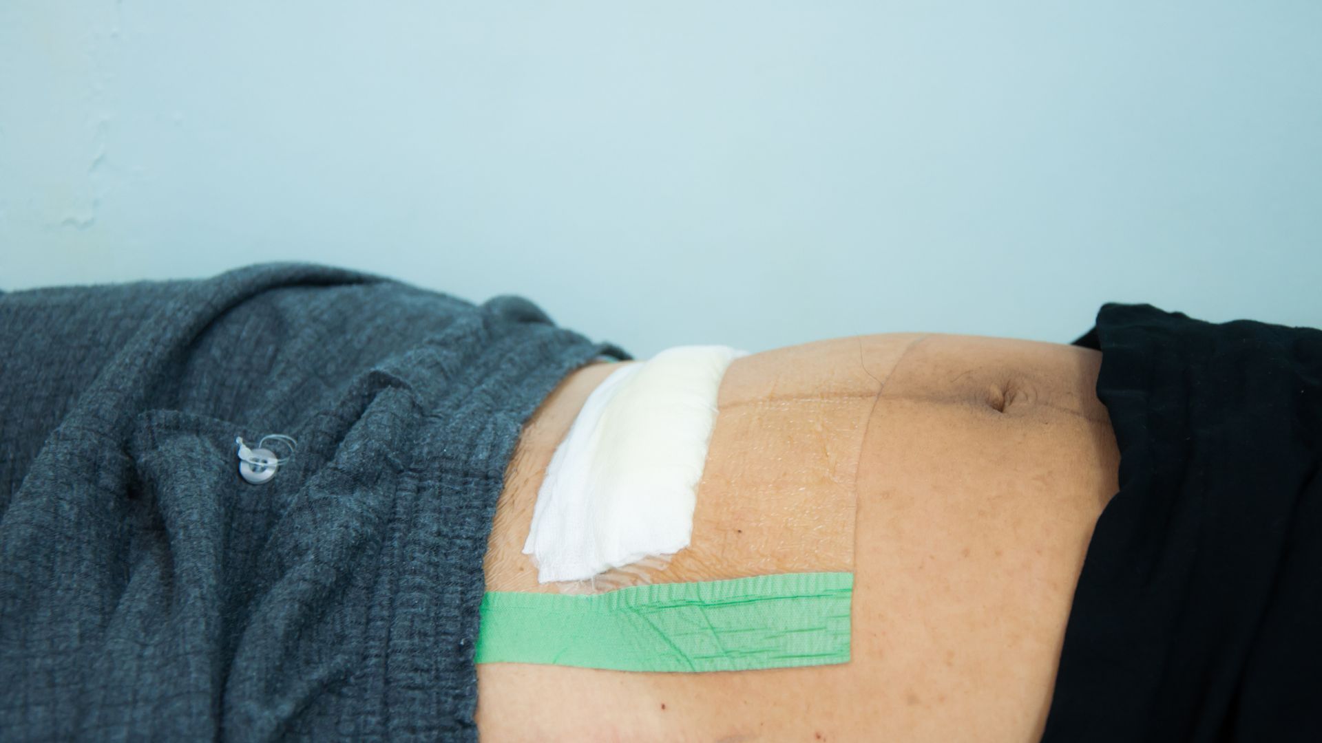 Vết mổ bị sưng đỏ có thể là dấu hiệu của nhiễm trùng