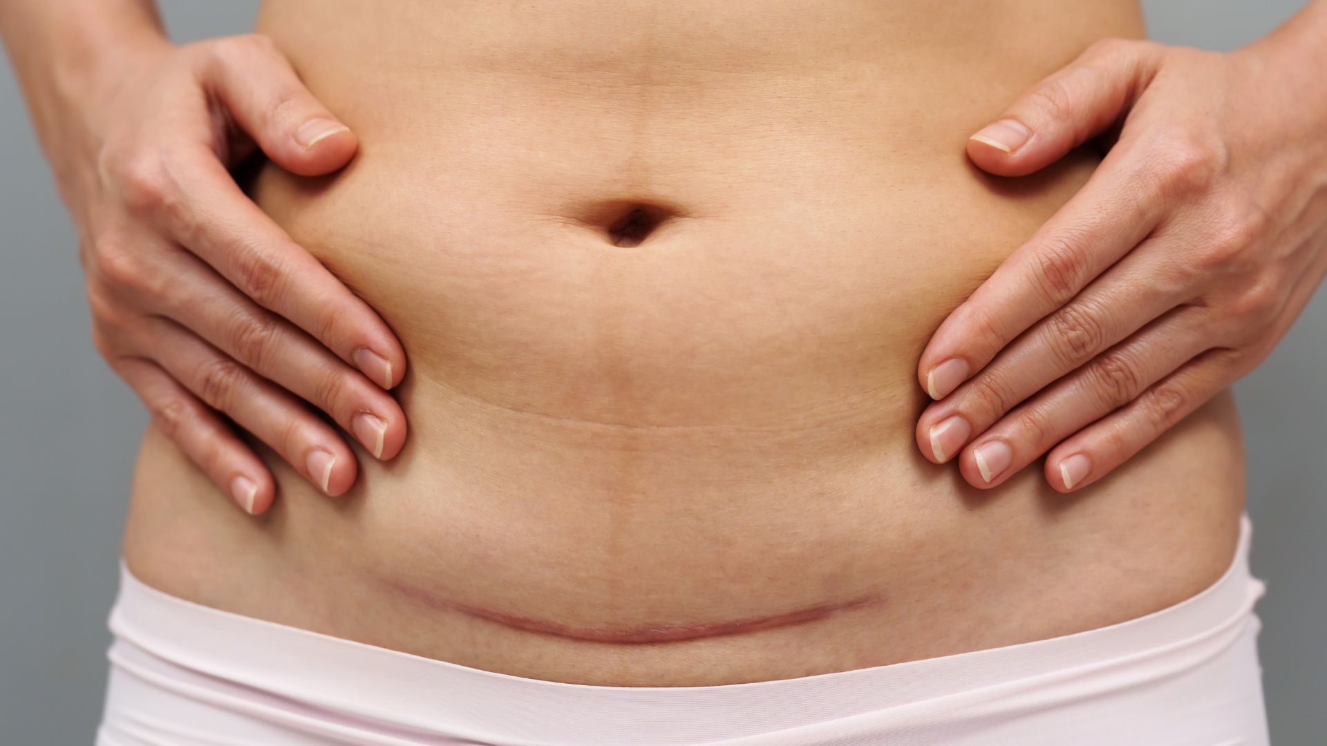 Mẹ cần giữ vết mổ luôn được khô và sạch để tránh bị nhiễm trùng