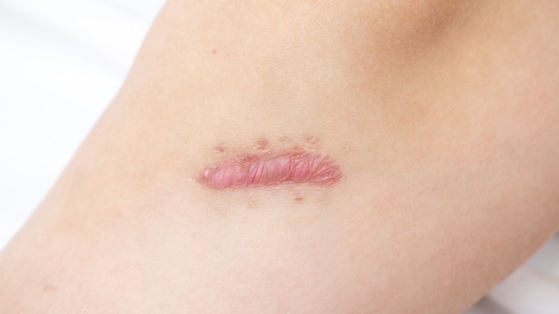 Vết mổ sau sinh bị lồi: Nguyên nhân, dấu hiệu và cách chăm sóc hiệu quả