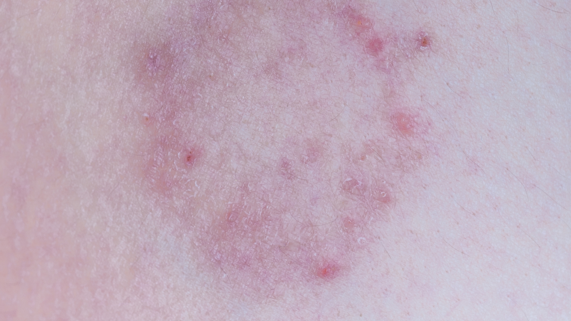 Nhiều người thường chủ quan với vết tròn bị nổi đốm đỏ trên da không ngứa, nhưng nó có thể liên quan đến một số bệnh lý tiềm ẩn nguy cơ